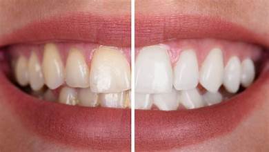 Teeth Whitening Before and After